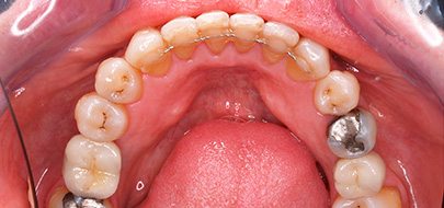 Ortodoncia + implantes
