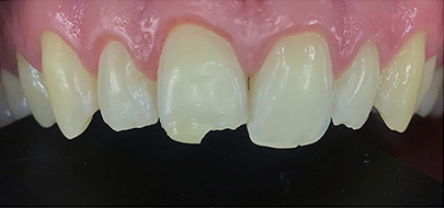 Carilles de composite