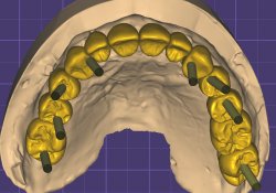 Implantes de Carga inmediata