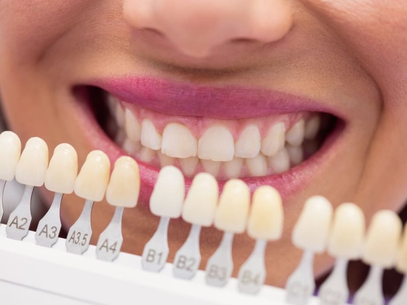Carillas de cerámica: Mejora tu sonrisa en Clínica Cuadros