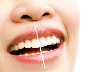 ¿Es seguro usar peróxido de hidrógeno en casa para blanquear los dientes?'