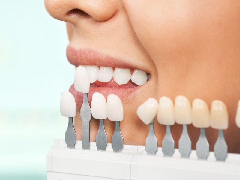 ¿Cuánto tiempo duran las carillas dentales y cómo cuidarlas?