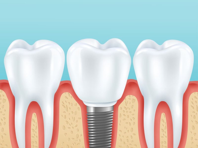 Anatomía de un implante dental: ¿de qué se compone?
