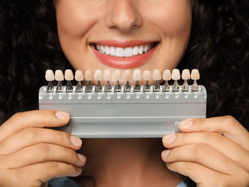 Carillas de zirconio: la opción más estética y duradera para tu sonrisa